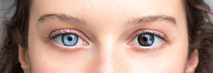 Heterochromia - Woman with Irises of 2 Distinct Colors
