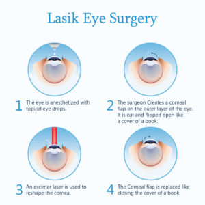 What to expect with Lasik during the surgery